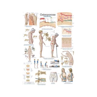 Plakat Osteoporoza, Plakat anatomiczny 50x70cm